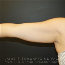 Arm Lift Before Photo by Jaime Schwartz, MD; Beverly Hills, CA - Case 31354