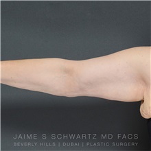 Arm Lift After Photo by Jaime Schwartz, MD; Beverly Hills, CA - Case 31355