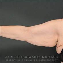Arm Lift Before Photo by Jaime Schwartz, MD; Beverly Hills, CA - Case 31355