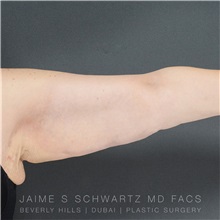 Arm Lift After Photo by Jaime Schwartz, MD; Beverly Hills, CA - Case 31355