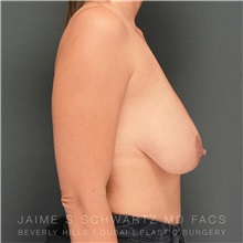 Breast Lift Before Photo by Jaime Schwartz, MD; Beverly Hills, CA - Case 31364
