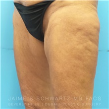 Thigh Lift Before Photo by Jaime Schwartz, MD; Beverly Hills, CA - Case 31371