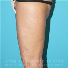 Thigh Lift After Photo by Jaime Schwartz, MD; Beverly Hills, CA - Case 31371