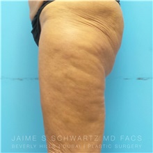 Thigh Lift Before Photo by Jaime Schwartz, MD; Beverly Hills, CA - Case 31371