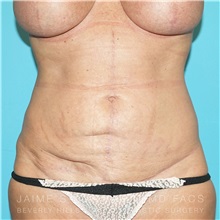 How An Upper Tummy Tuck and Bra Line Back Lift Can Reshape Your Upper Body  - Jaime Schwartz MD, FACS
