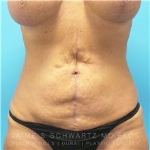 Scar Revision Before Photo by Jaime Schwartz, MD; Beverly Hills, CA - Case 31373