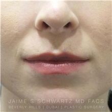 Lip Augmentation/Enhancement After Photo by Jaime Schwartz, MD; Beverly Hills, CA - Case 31378