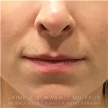 Lip Augmentation/Enhancement Before Photo by Jaime Schwartz, MD; Beverly Hills, CA - Case 31378