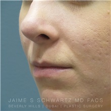 Lip Augmentation/Enhancement Before Photo by Jaime Schwartz, MD; Beverly Hills, CA - Case 31378