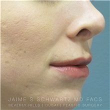Lip Augmentation/Enhancement After Photo by Jaime Schwartz, MD; Beverly Hills, CA - Case 31378