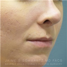 Lip Augmentation/Enhancement Before Photo by Jaime Schwartz, MD; Beverly Hills, CA - Case 31378