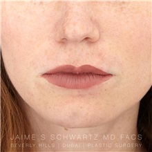 Lip Augmentation/Enhancement After Photo by Jaime Schwartz, MD; Beverly Hills, CA - Case 31669