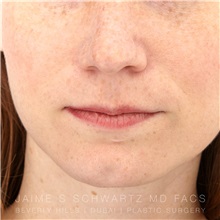 Lip Augmentation/Enhancement Before Photo by Jaime Schwartz, MD; Beverly Hills, CA - Case 31669