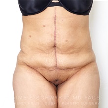 Tummy Tuck After Photo by Jaime Schwartz, MD; Beverly Hills, CA - Case 31759