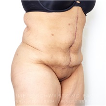 Tummy Tuck After Photo by Jaime Schwartz, MD; Beverly Hills, CA - Case 31759