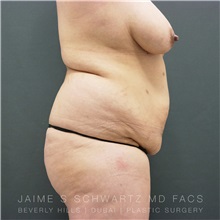 Tummy Tuck Before Photo by Jaime Schwartz, MD; Beverly Hills, CA - Case 31759
