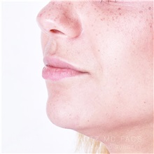 Lip Augmentation/Enhancement Before Photo by Jaime Schwartz, MD; Beverly Hills, CA - Case 32364