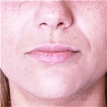 Lip Augmentation/Enhancement Before Photo by Jaime Schwartz, MD; Beverly Hills, CA - Case 32364