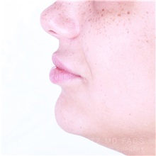 Lip Augmentation/Enhancement After Photo by Jaime Schwartz, MD; Beverly Hills, CA - Case 32364