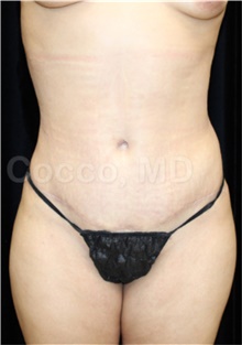Tummy Tuck After Photo by Jennyfer Faridy Cocco, MD; Dallas, TX - Case 48371