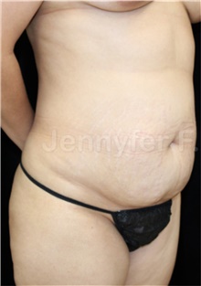Tummy Tuck Before Photo by Jennyfer Faridy Cocco, MD; Dallas, TX - Case 48371