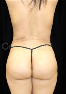 Tummy Tuck After Photo by Jennyfer Faridy Cocco, MD; Dallas, TX - Case 48371