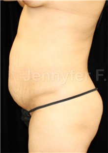 Tummy Tuck Before Photo by Jennyfer Faridy Cocco, MD; Dallas, TX - Case 48371