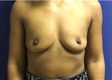 Breast Augmentation Before Photo by Timothy Mountcastle, MD; ashburn, VA - Case 29986