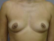 Breast Augmentation Before Photo by Timothy Mountcastle, MD; Ashburn, VA - Case 29992