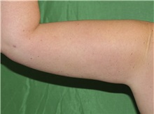 Liposuction After Photo by Timothy Mountcastle, MD; Ashburn, VA - Case 29996