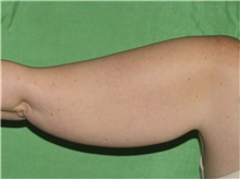 Liposuction Before Photo by Timothy Mountcastle, MD; Ashburn, VA - Case 29996