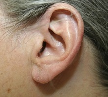 Ear Surgery After Photo by Timothy Mountcastle, MD; Ashburn, VA - Case 29997