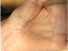 Hand Surgery After Photo by Timothy Mountcastle, MD; Ashburn, VA - Case 30007