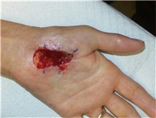 Hand Surgery Before Photo by Timothy Mountcastle, MD; Ashburn, VA - Case 30007