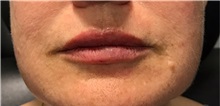 Dermal Fillers After Photo by Timothy Mountcastle, MD; ashburn, VA - Case 30089