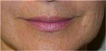 Dermal Fillers Before Photo by Timothy Mountcastle, MD; Ashburn, VA - Case 30089