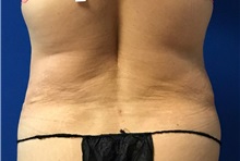 Liposuction After Photo by Timothy Mountcastle, MD; Ashburn, VA - Case 30101