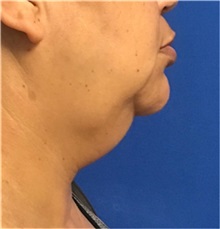 Liposuction Before Photo by Timothy Mountcastle, MD; Ashburn, VA - Case 30161
