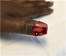 Hand Surgery Before Photo by Timothy Mountcastle, MD; Ashburn, VA - Case 30178