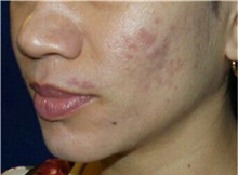 Chemical Peels, IPL, Fractional CO2 Laser Treatments After Photo by Timothy Mountcastle, MD; Ashburn, VA - Case 30480