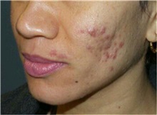 Chemical Peels, IPL, Fractional CO2 Laser Treatments Before Photo by Timothy Mountcastle, MD; Ashburn, VA - Case 30480