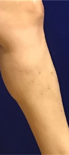 Vascular Malformations After Photo by Timothy Mountcastle, MD; Ashburn, VA - Case 30537