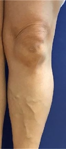 Vascular Malformations Before Photo by Timothy Mountcastle, MD; Ashburn, VA - Case 30537