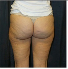 Body Contouring Before Photo by Timothy Mountcastle, MD; Ashburn, VA - Case 30538