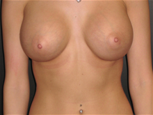 Breast Augmentation After Photo by Valerie Wright, MD; , TX - Case 25925