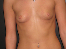 Breast Augmentation Before Photo by Valerie Wright, MD; , TX - Case 25925