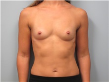 Breast Augmentation Before Photo by Tommaso Addona, MD; Garden City, NY - Case 30386