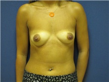 Breast Augmentation Before Photo by Tommaso Addona, MD; Garden City, NY - Case 30387