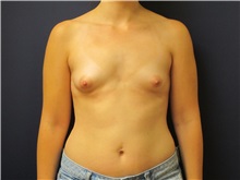 Breast Augmentation Before Photo by Tommaso Addona, MD; Garden City, NY - Case 30388