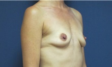 Breast Augmentation Before Photo by Tommaso Addona, MD; Garden City, NY - Case 34970